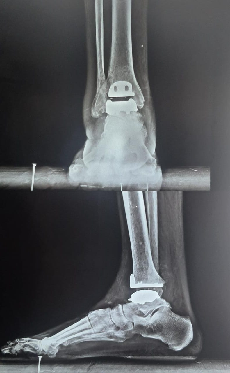 First H3 Total Ankle Replacement India